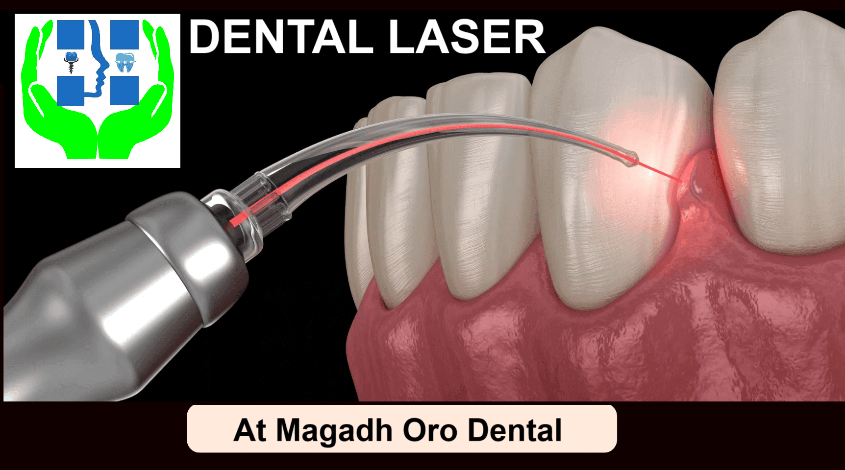 Laser Gum's Treatment :  Benefits and Cost in Patna | Dr. Abhishek Kumar