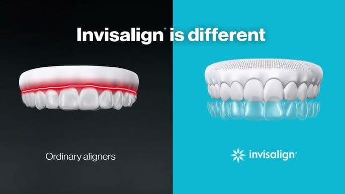 Why Invisalign is better than Other Aligner in Patna