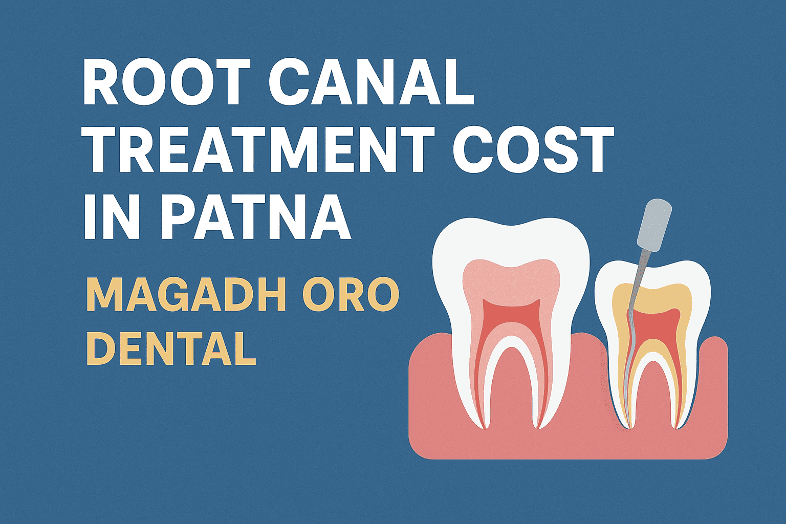  Root Canal Treatment in Patna – Cost, Procedure & Factors Explained