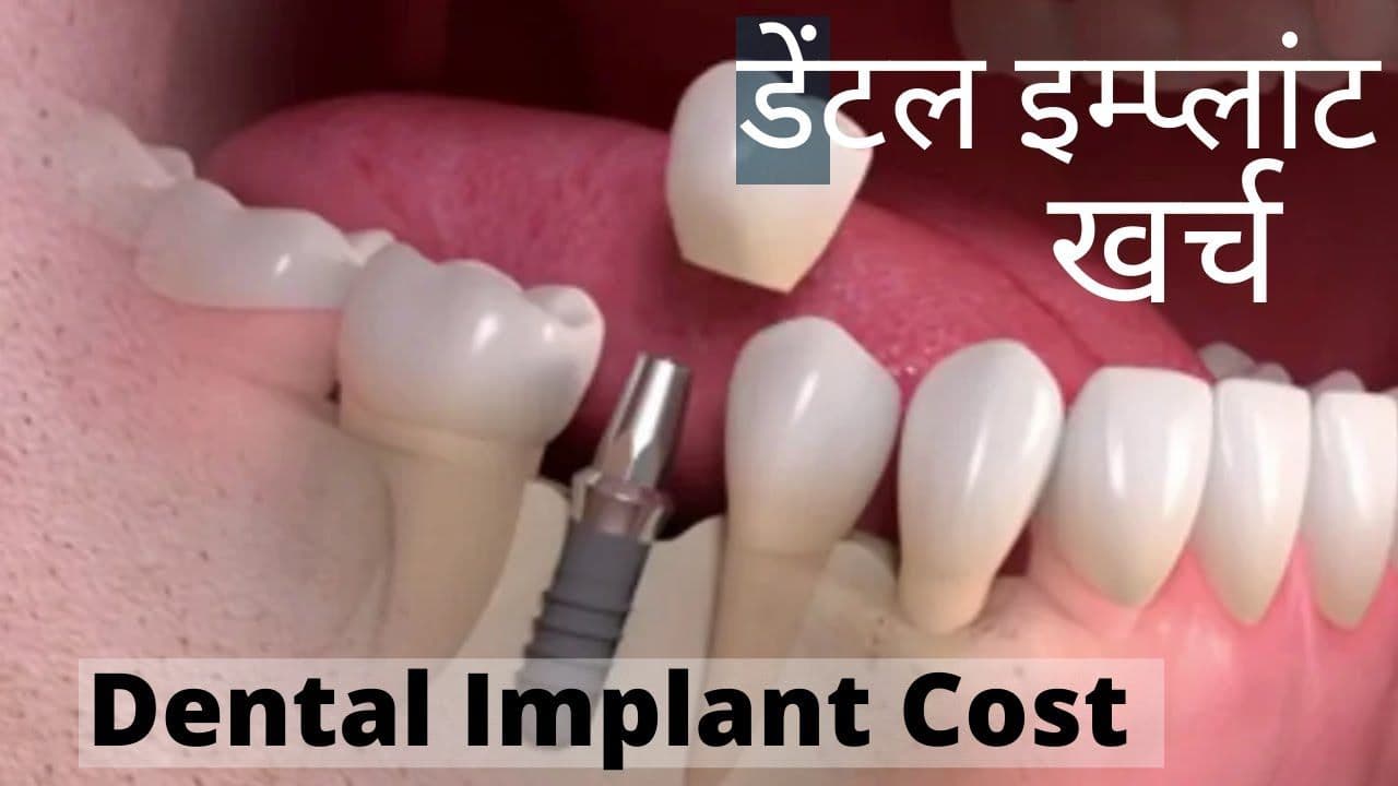 Cost of Dental Implants in Patna