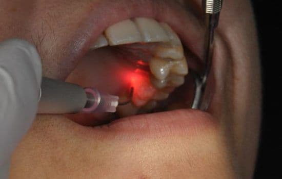 Laser Root Canal Treatment : Procedure and Cost in Patna 