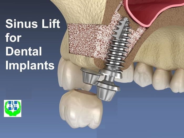Maxillary Sinus Lift : Procedure and Cost in Patna