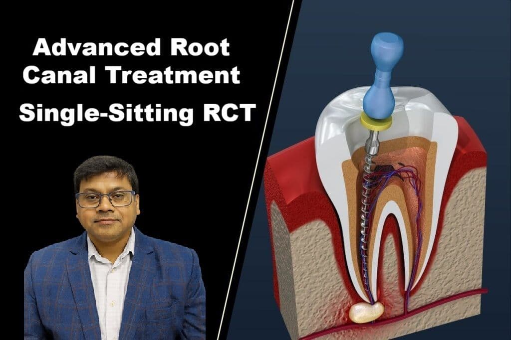 Advanced Root Canal Treatment in Patna | Single-Sitting RCT | Magadh Oro Dental