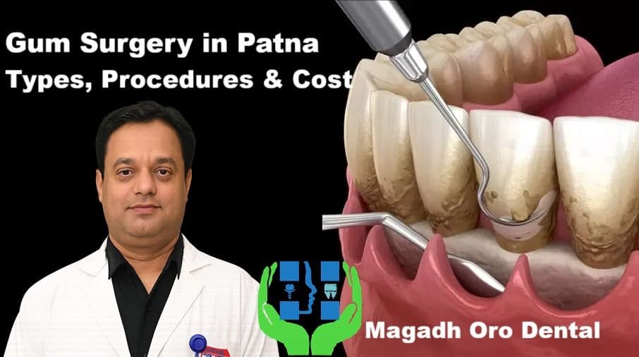 Gum Surgery in Patna | Types, Procedures and Cost at Magadh Oro Dental