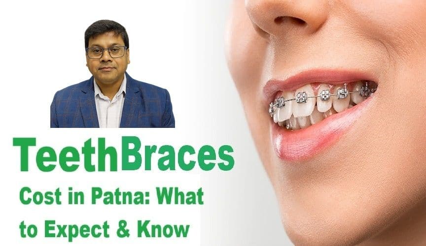 Teeth Braces Cost in Patna: What to Expect & Know