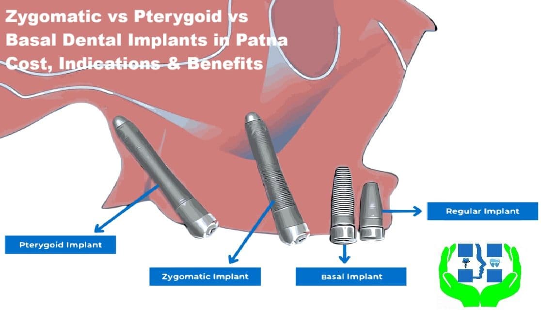 Zygomatic vs Pterygoid vs Basal Dental Implants in Patna | Cost, Indications & Benefits