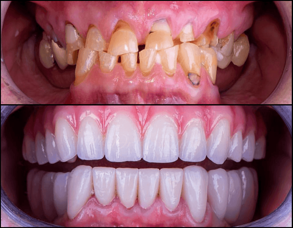 Full Mouth Rehabilitation in Patna | Magadh Oro Dental