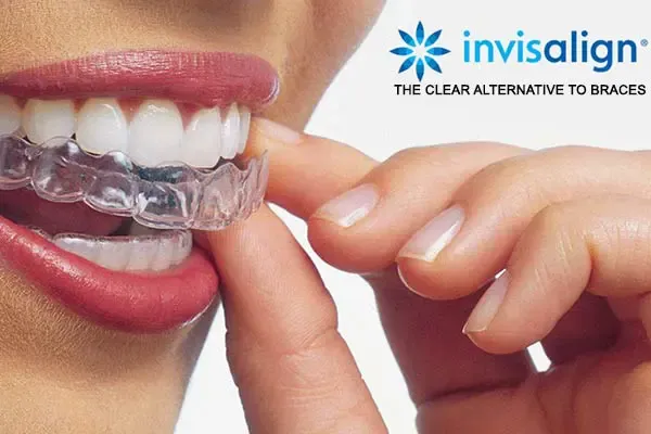 Invisalign Treatment in Patna | Invisible Braces | Magadh Oro Dental